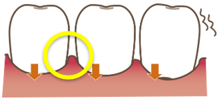歯肉の状態について